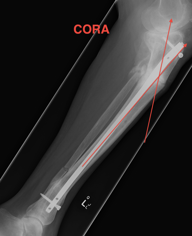 CORA Lateral